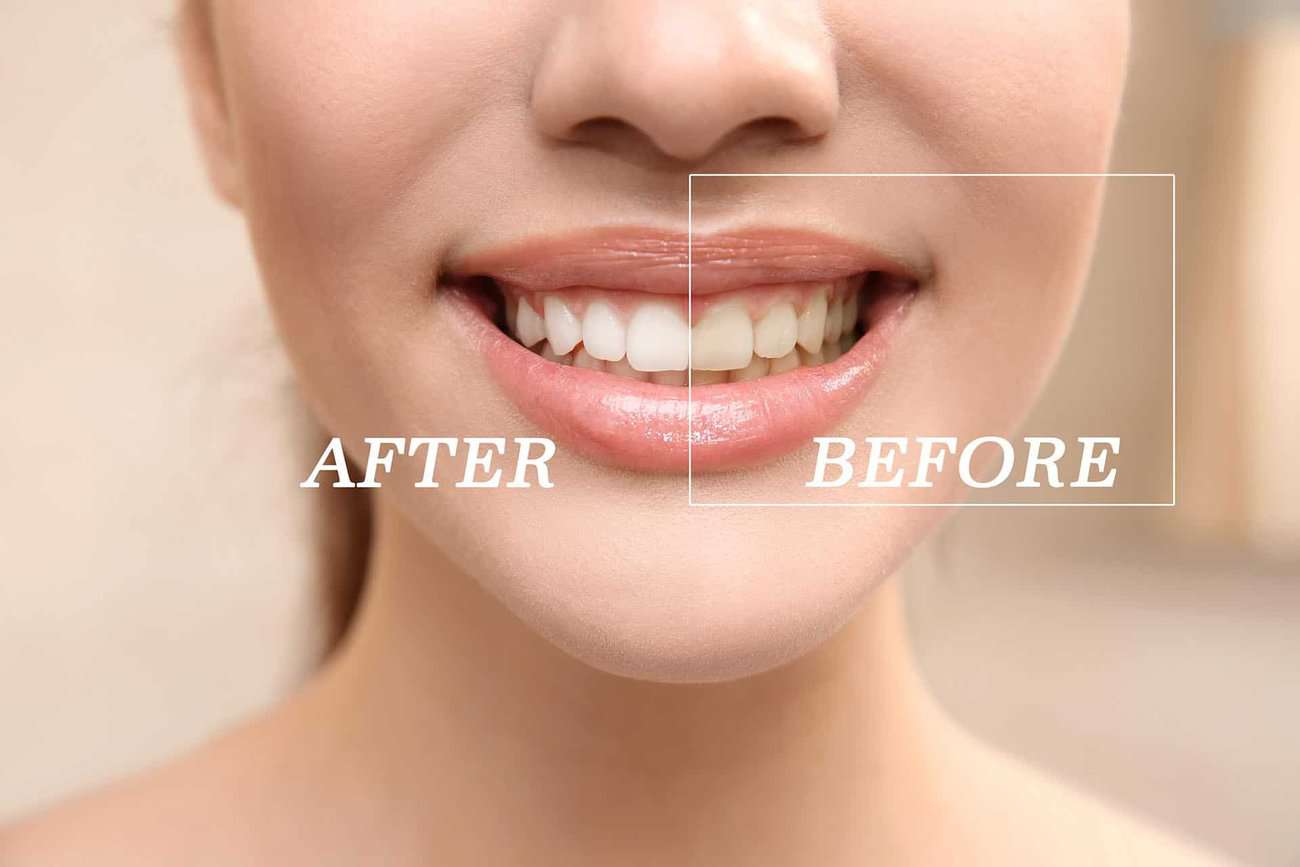 What Are the Most Effective Natural Teeth Whitening Methods You Can Try Abingdon?