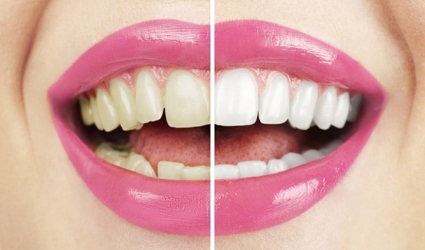 What Makes Ultima White Teeth Whitening Different Abingdon