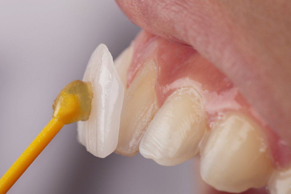 Why Do Dental Crowns Fail or Get Damaged Prematurely Abingdon?