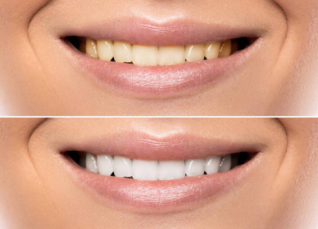 How Does Gum Disease Progress if Left Untreated Abingdon?