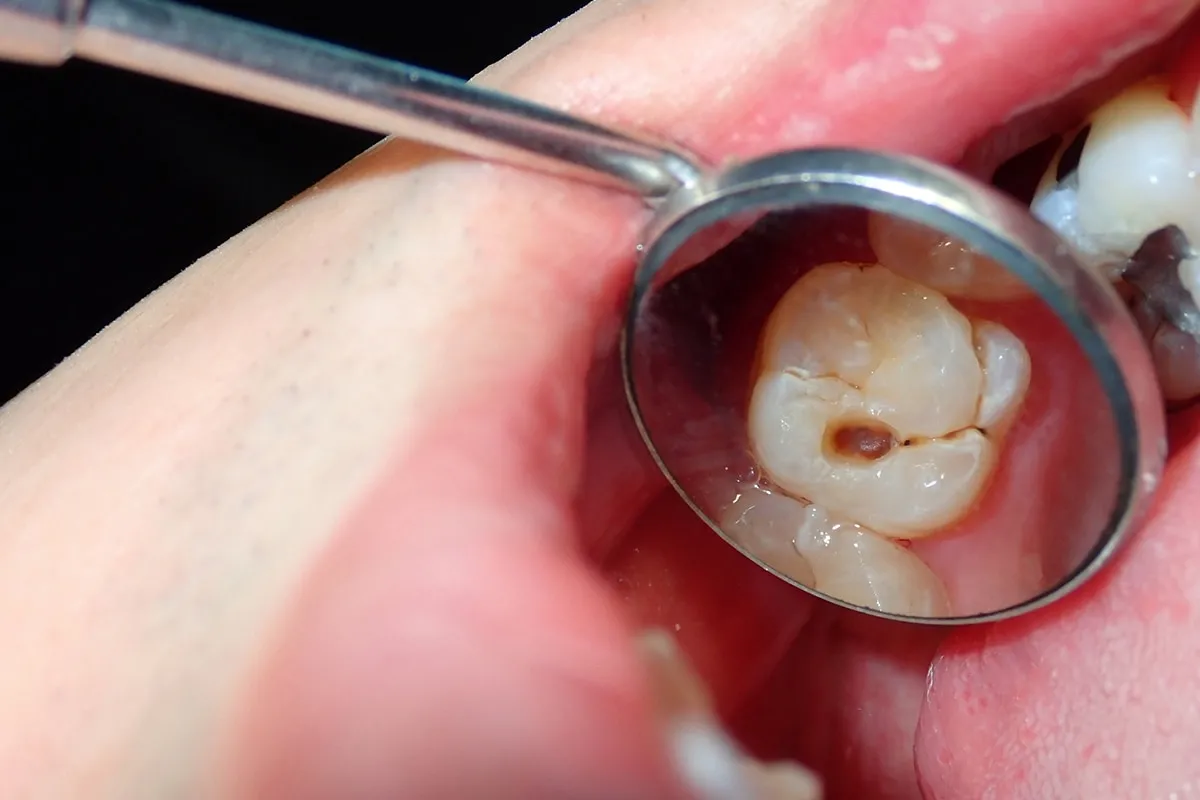 Why Do Teeth Crack? Common Causes to Know Abingdon