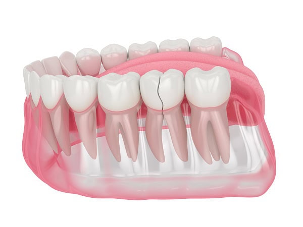 How Can You Manage Pain and Discomfort After a Root Canal Abingdon?