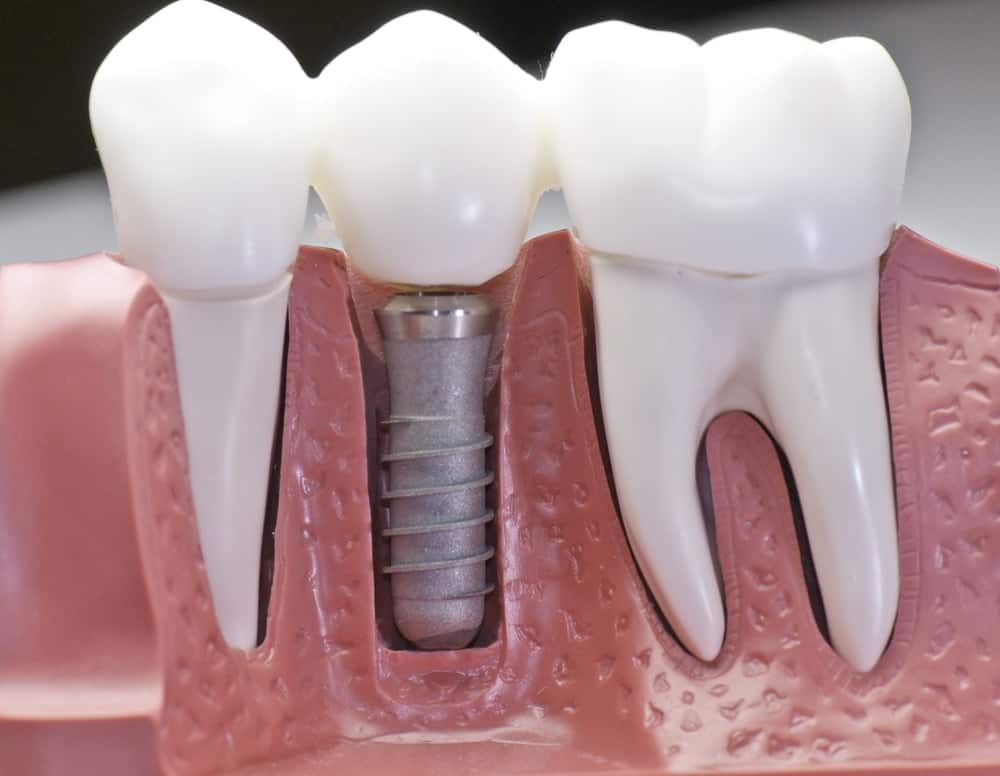 Who Is a Good Candidate for Dental Implants Abingdon?