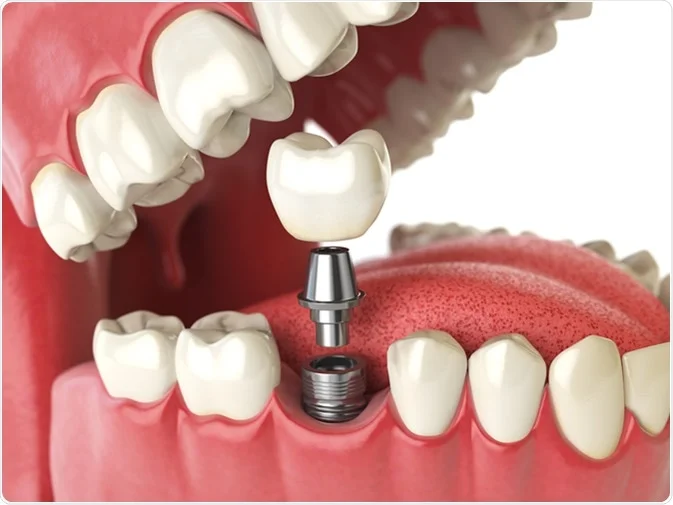 How Do I Decide Which Tooth Replacement Is Right for Me Abingdon?