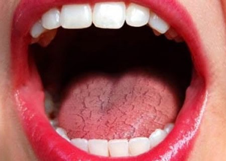 Common Causes of Dry Mouth (Xerostomia) Abingdon