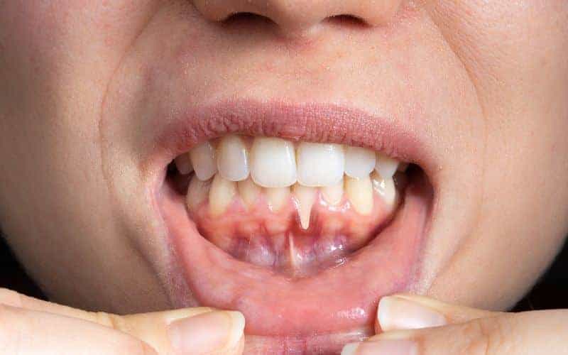 How Can Gum Disease Be Prevented Abingdon?