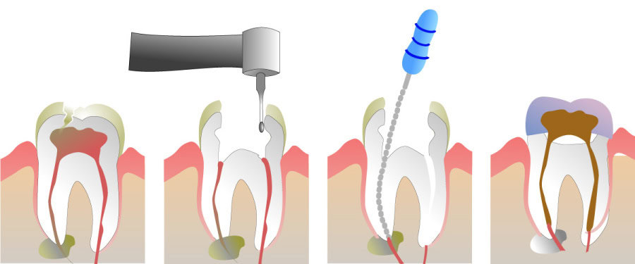 How Do You Properly Care for Your Teeth After a Root Canal Abingdon