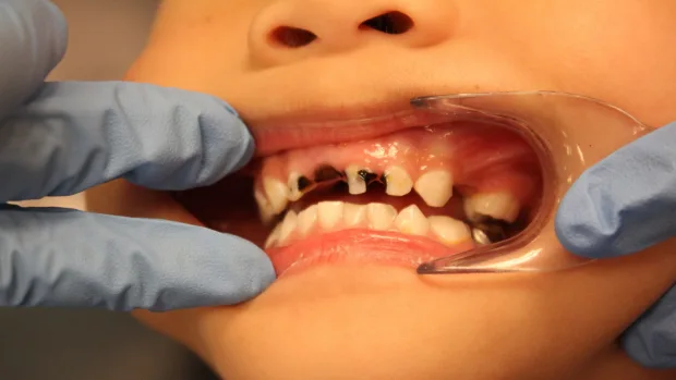 Which Foods and Drinks Cause the Most Damage to Young Smiles Abingdon?