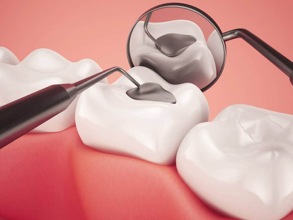 Fighting Cavities and Plaque Buildup Abingdon