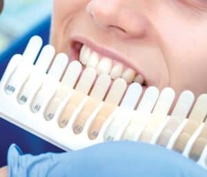Ultimate Guide to Teeth Whitening with Natural Ingredients Abingdon
