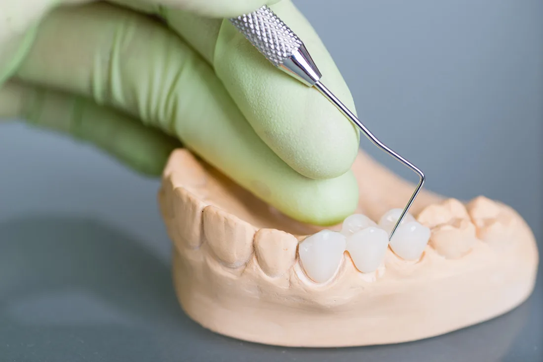 What Are the Different Types of Dental Crowns Available Abingdon?