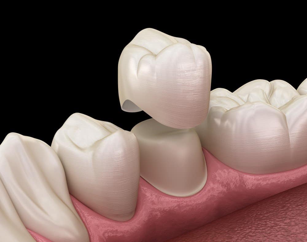 What is the Procedure for Getting Dental Implants Abingdon?