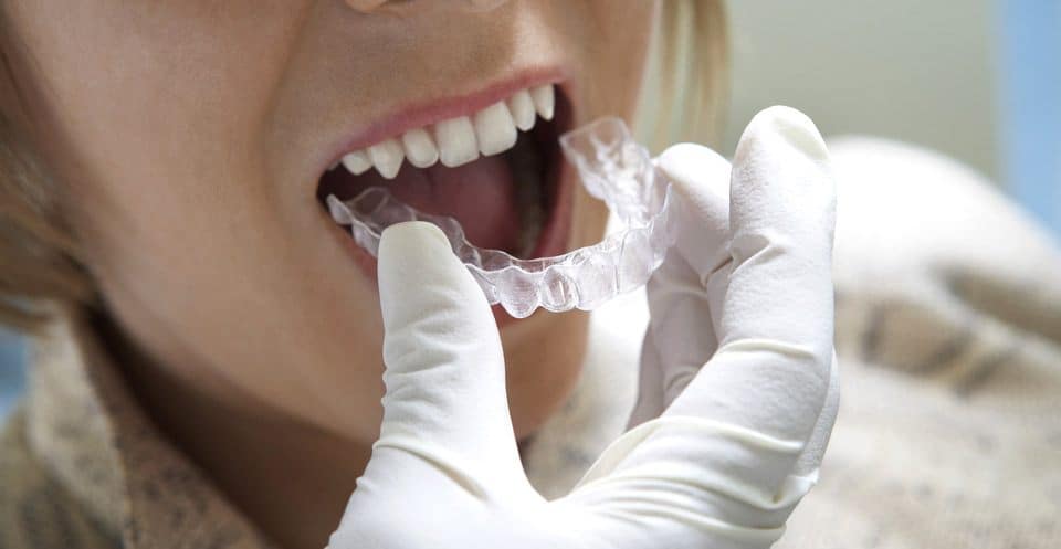How Much Does Laser Teeth Whitening Cost Compared to Overnight Trays Abingdon?